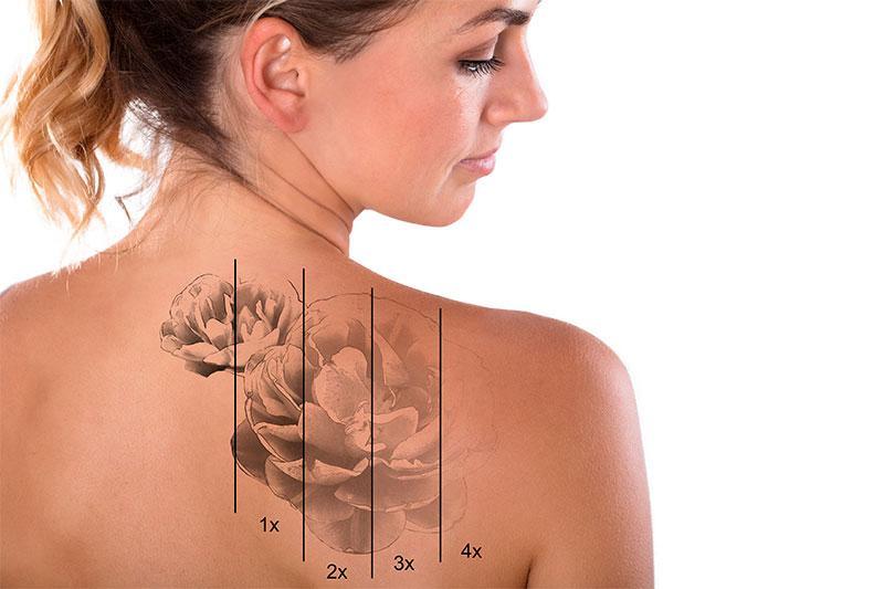 Suppression des tatouages en plusieurs étapes avec i-depil.